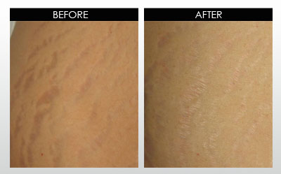 stretch marks
